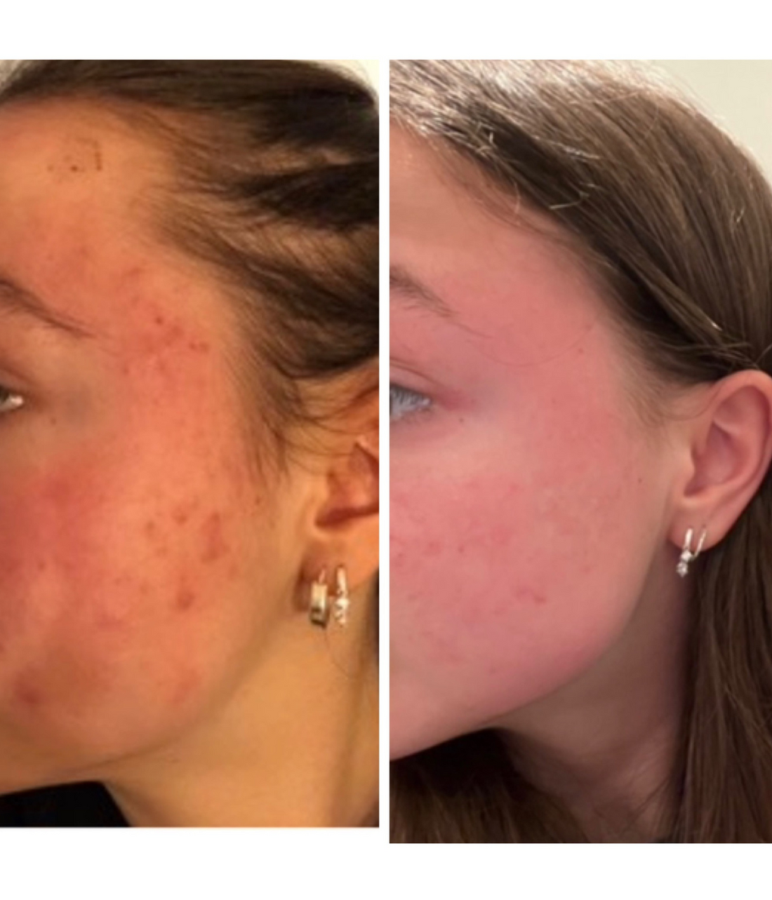 behandling af acne 