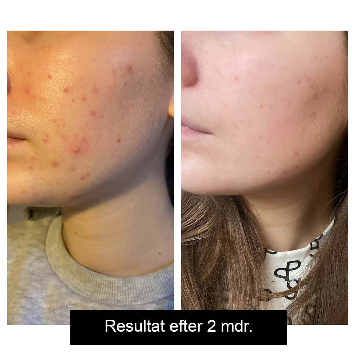 Skin Clear Biome ™ - Mavevenlige bakterier til problemhud